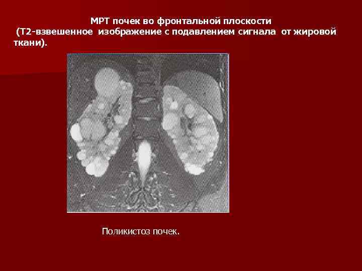 МРТ почек во фронтальной плоскости (Т 2 -взвешенное изображение с подавлением сигнала от жировой