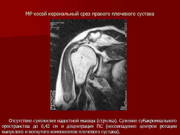  МР косой корональный срез правого плечевого сустава Отсутствие сухожилия надостной мышцы (стрелка). Сужение