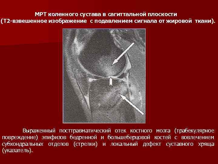 Инфаркт костного мозга коленного. Отёк костного мозга коленного сустава на мрт. Мрт коленного сустава отек костного мозга. Изображения с подавлением сигнала от жировой ткани. Костный мозг бедренной кости.