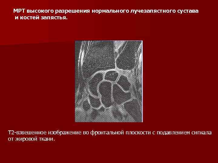 МРТ высокого разрешения нормального лучезапястного сустава и костей запястья. Т 2 взвешенное изображение во