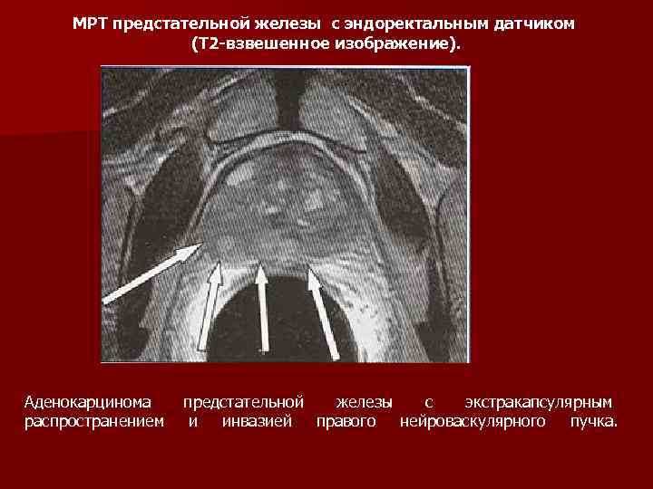 Схема предстательной железы мрт