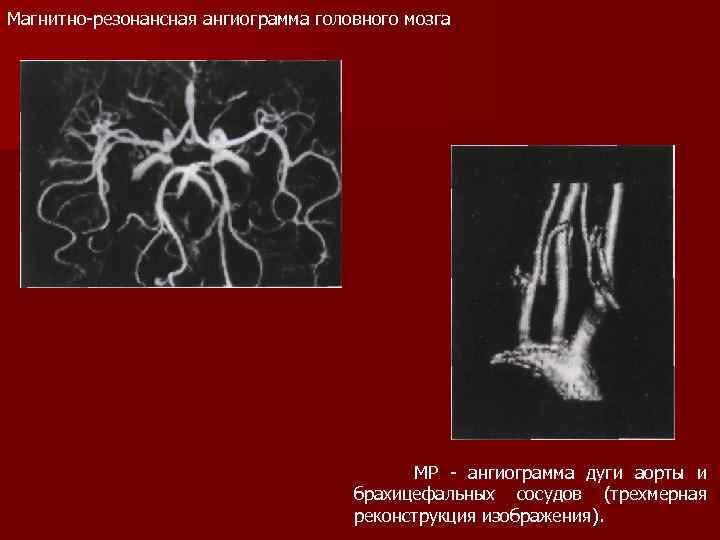 Магнитно резонансная ангиограмма головного мозга МР ангиограмма дуги аорты и брахицефальных сосудов (трехмерная реконструкция