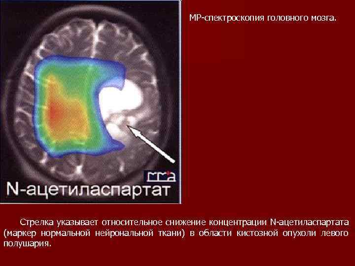 МР спектроскопия головного мозга. Стрелка указывает относительное снижение концентрации N ацетиласпартата (маркер нормальной нейрональной
