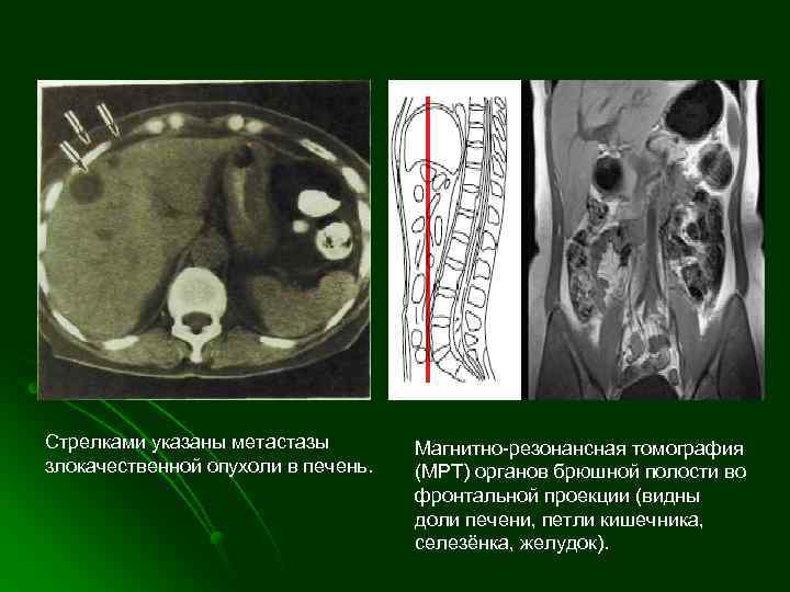 Стрелками указаны метастазы злокачественной опухоли в печень. Магнитно-резонансная томография (МРТ) органов брюшной полости во