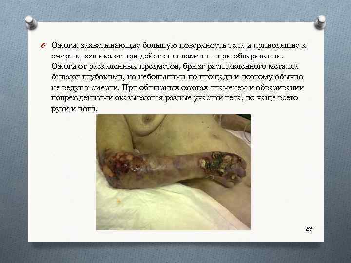 O Ожоги, захватывающие большую поверхность тела и приводящие к смерти, возникают при действии пламени