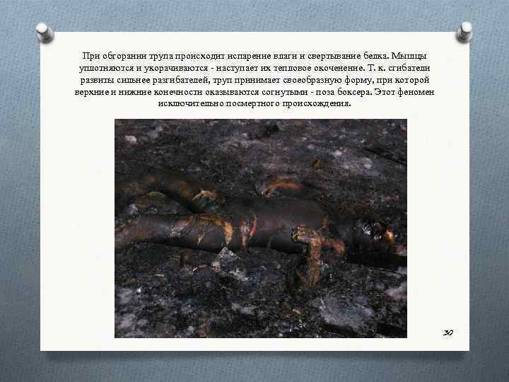 При обгорании трупа происходит испарение влаги и свертывание белка. Мышцы уплотняются и укорачиваются наступает