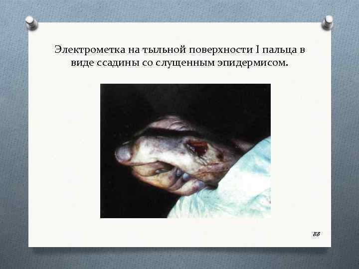 Электрометка на тыльной поверхности I пальца в виде ссадины со слущенным эпидермисом. 88 