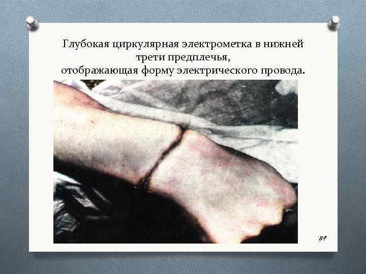 Глубокая циркулярная электрометка в нижней трети предплечья, отображающая форму электрического провода. 89 