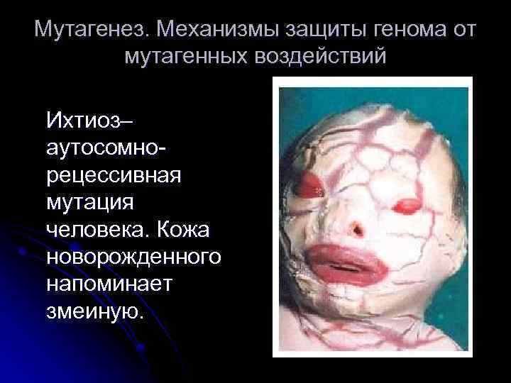 Мутагенез. Механизмы защиты генома от мутагенных воздействий Ихтиоз– аутосомнорецессивная мутация человека. Кожа новорожденного напоминает