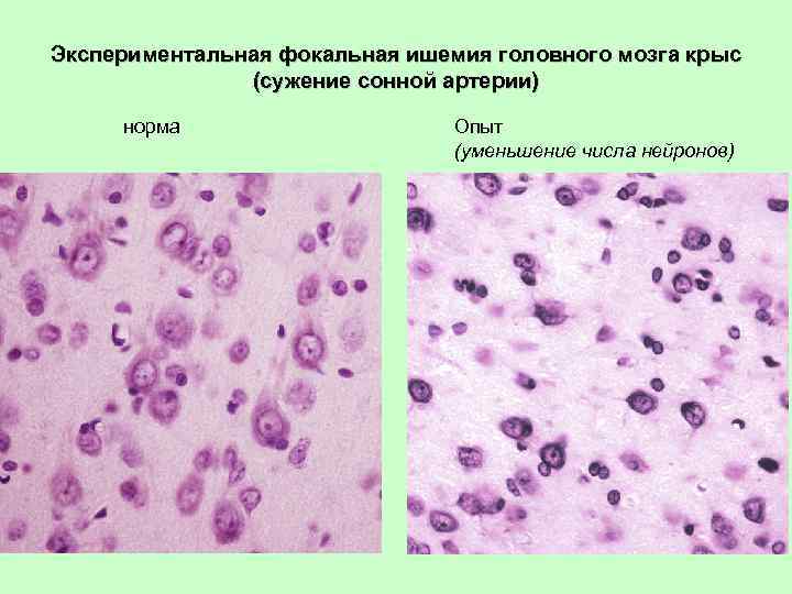 Экспериментальная фокальная ишемия головного мозга крыс (сужение сонной артерии) норма Опыт (уменьшение числа нейронов)