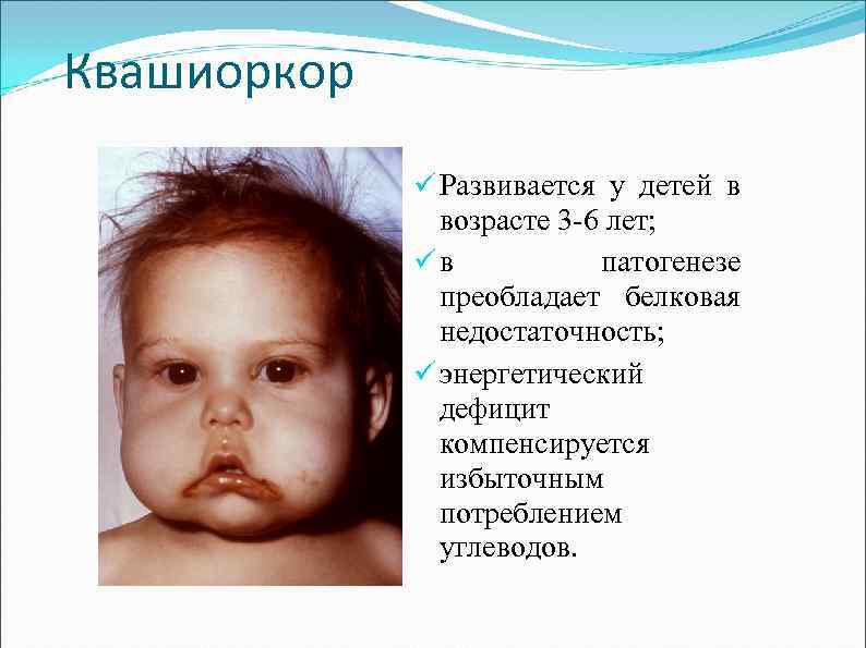 Квашиоркор ü Развивается у детей в возрасте 3 -6 лет; üв патогенезе преобладает белковая