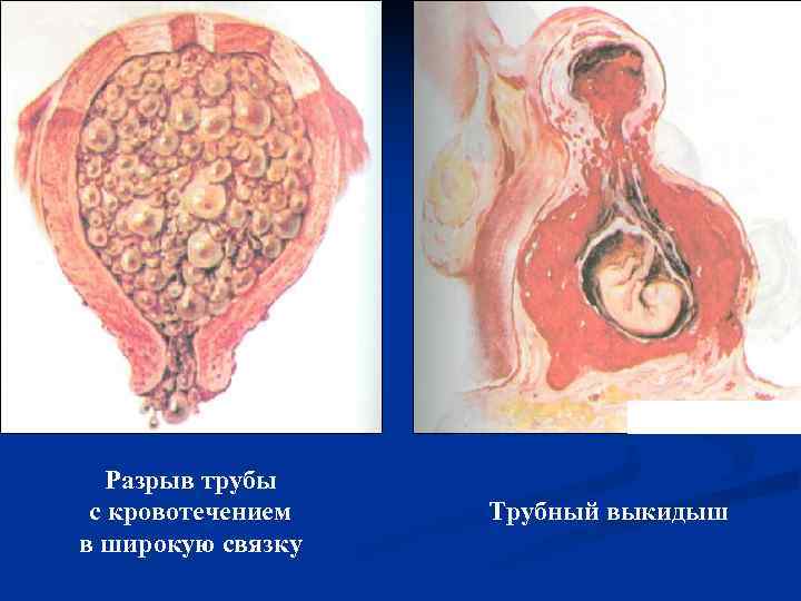  Разрыв трубы  с кровотечением  Трубный выкидыш в широкую связку 