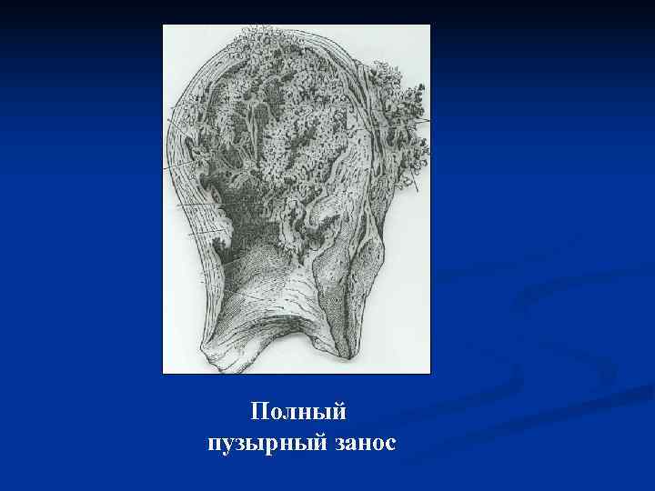   Полный пузырный занос 