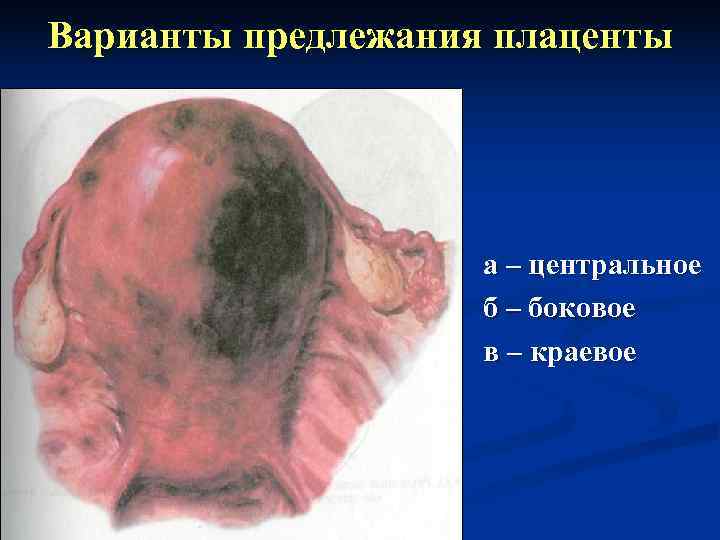 Варианты предлежания плаценты     а – центральное    