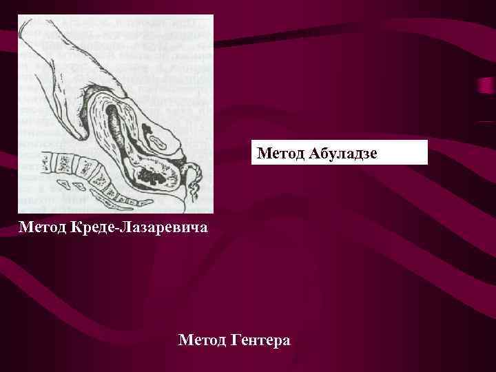       Метод Абуладзе  Метод Креде-Лазаревича   