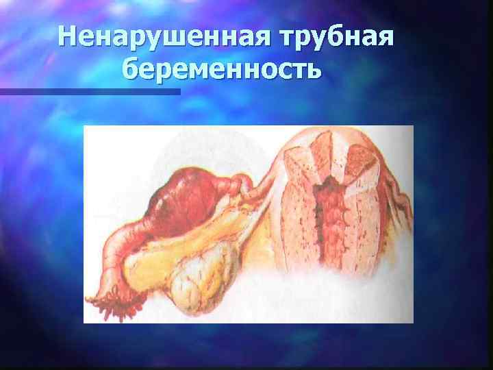 Ненарушенная трубная беременность 