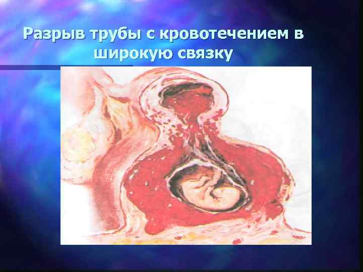 Разрыв трубы с кровотечением в  широкую связку 