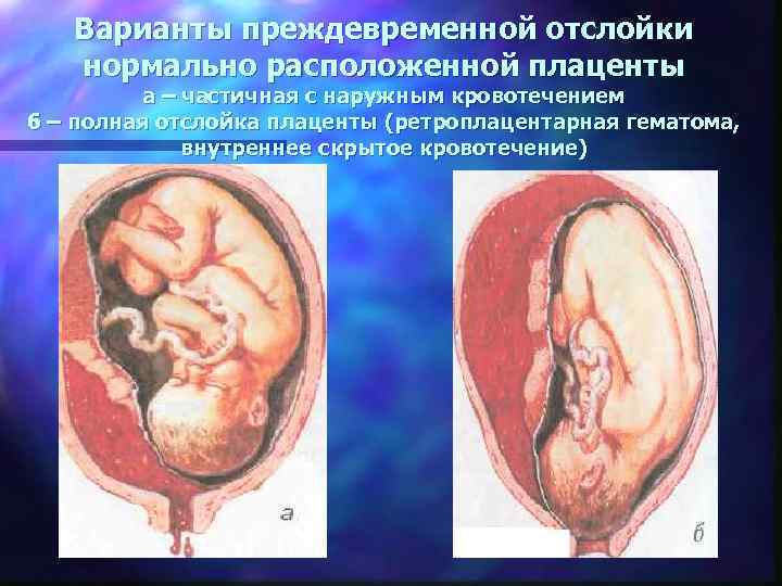   Варианты преждевременной отслойки  нормально расположенной плаценты   а – частичная