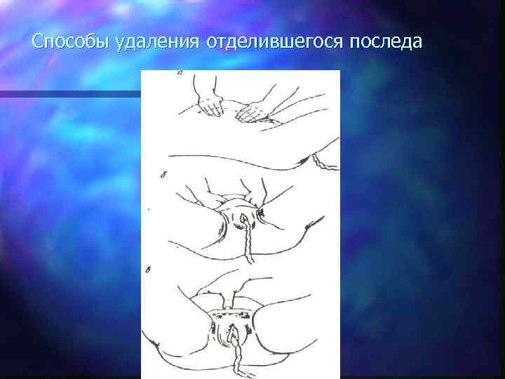 Способы удаления отделившегося последа 
