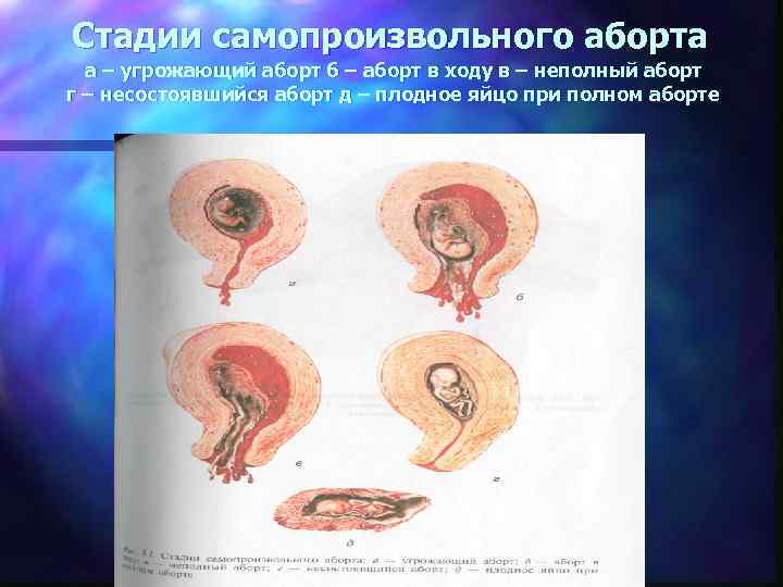 Кровотечение во время беременности презентация