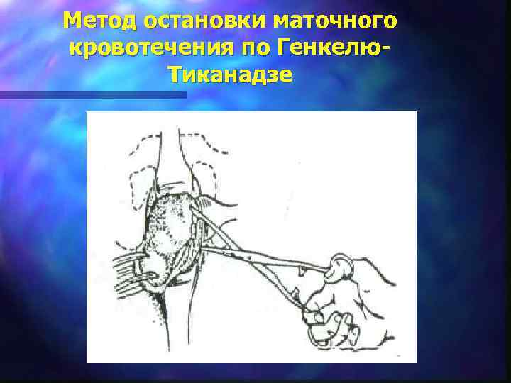 Метод остановки маточного кровотечения по Генкелю-   Тиканадзе 