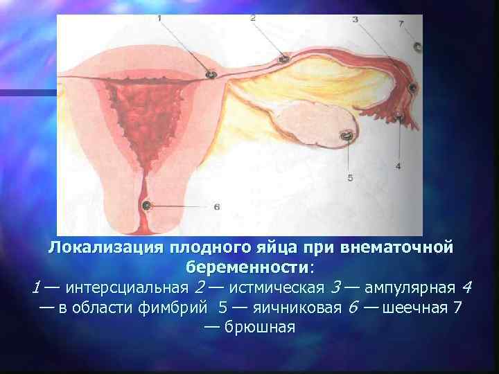  Локализация плодного яйца при внематочной    беременности:  1 — интерсциальная