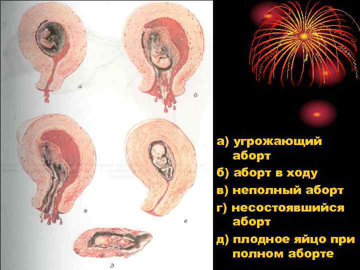 а) угрожающий  аборт б) аборт в ходу в) неполный аборт г) несостоявшийся 