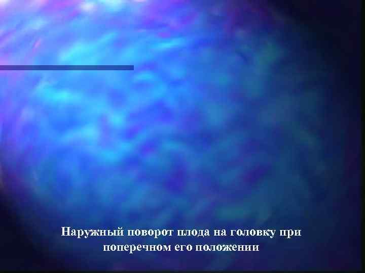 Наружный поворот плода на головку при  поперечном его положении 