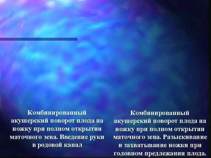  Комбинированный    Комбинированный акушерский поворот плода на  ножку при полном