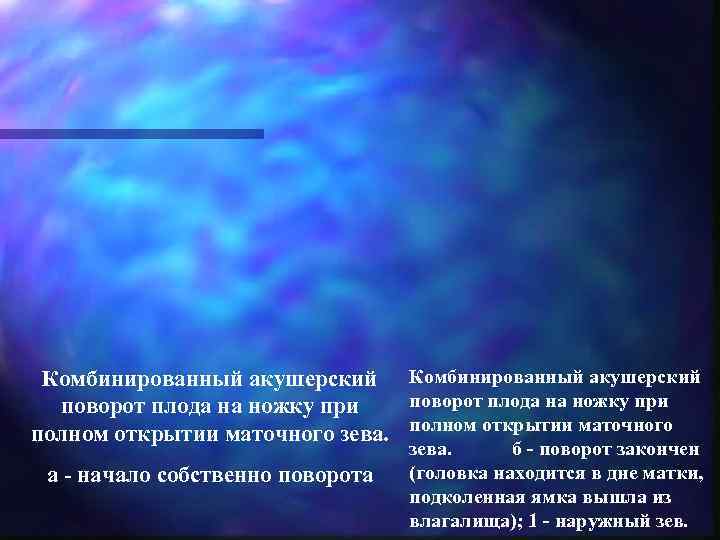  Комбинированный акушерский  поворот плода на ножку при полном открытии маточного зева. полном