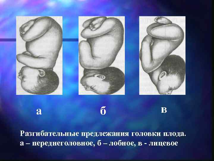   а    б    в Разгибательные предлежания головки