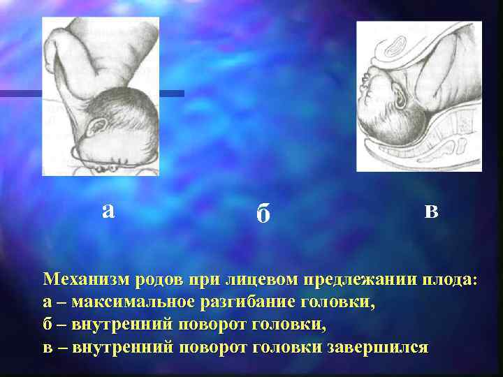  а    б    в Механизм родов при лицевом