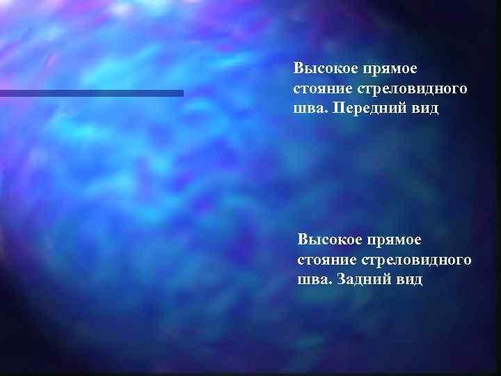 Высокое прямое стояние стреловидного шва. Передний вид Высокое прямое стояние стреловидного шва. Задний вид