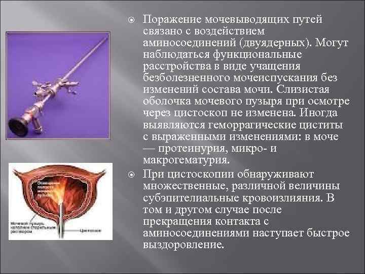   Поражение мочевыводящих путей связано с воздействием аминосоединений (двуядерных). Могут наблюдаться функциональные расстройства
