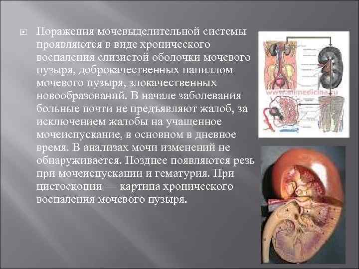   Поражения мочевыделительной системы проявляются в виде хронического воспаления слизистой оболочки мочевого пузыря,