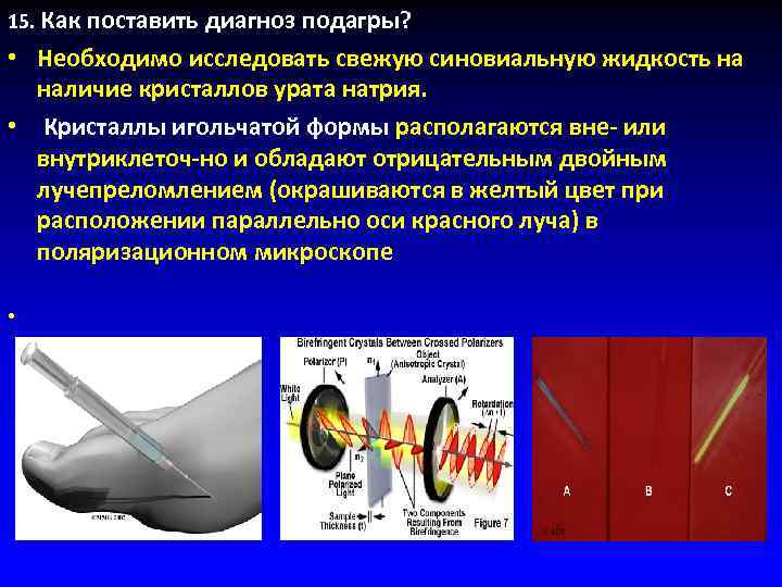 15. Как поставить диагноз подагры? • Необходимо исследовать свежую синовиальную жидкость на  наличие