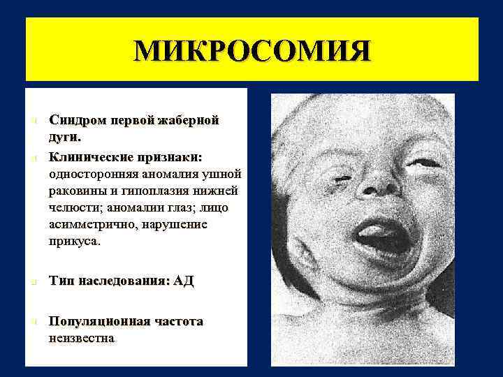 МИКРОСОМИЯ n n Синдром первой жаберной дуги. Клинические признаки: односторонняя аномалия ушной раковины и
