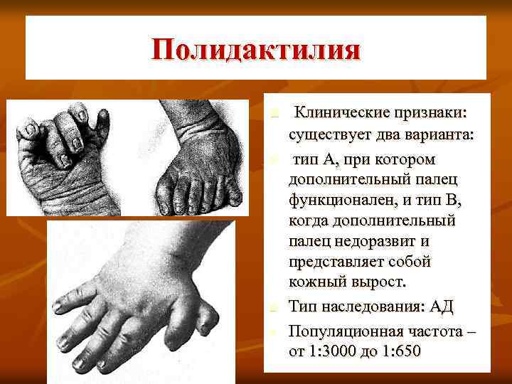 Полидактилия n n Клинические признаки: существует два варианта: тип А, при котором дополнительный палец