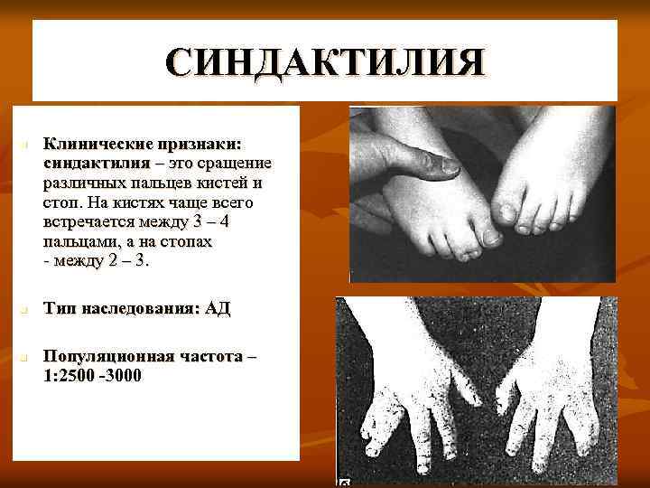 СИНДАКТИЛИЯ n n n Клинические признаки: синдактилия – это сращение различных пальцев кистей и