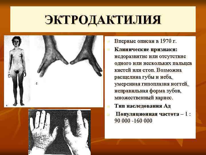 ЭКТРОДАКТИЛИЯ n n Впервые описан в 1970 г. Клинические признаки: недоразвитие или отсутствие одного