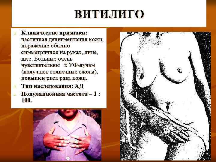 ВИТИЛИГО n n n Клинические признаки: частичная депигментация кожи; поражение обычно симметричное на руках,