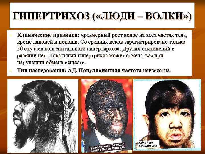 ГИПЕРТРИХОЗ ( «ЛЮДИ – ВОЛКИ» ) n n Клинические признаки: чрезмерный рост волос на