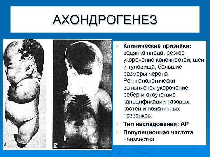 АХОНДРОГЕНЕЗ Клинические признаки: водянка плода, резкое укорочение конечностей, шеи и туловища, большие размеры черепа.