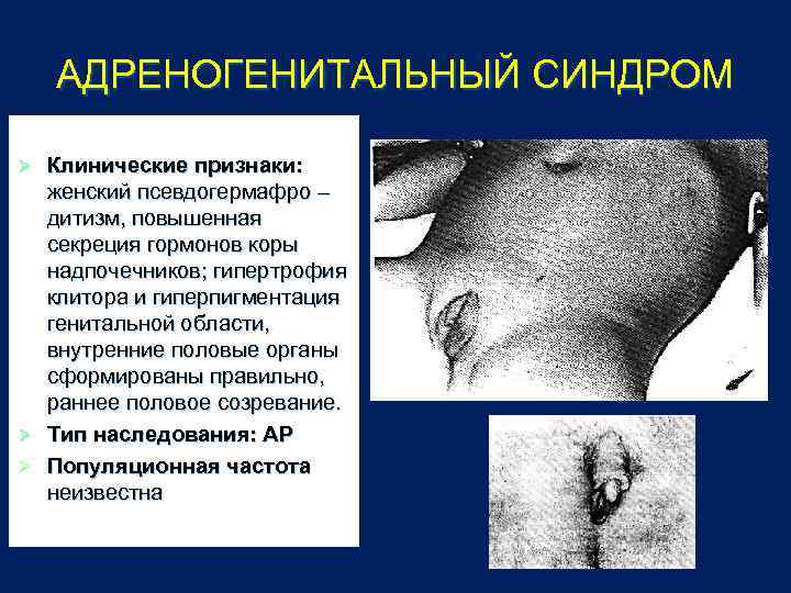 АДРЕНОГЕНИТАЛЬНЫЙ СИНДРОМ Клинические признаки: женский псевдогермафро – дитизм, повышенная секреция гормонов коры надпочечников; гипертрофия
