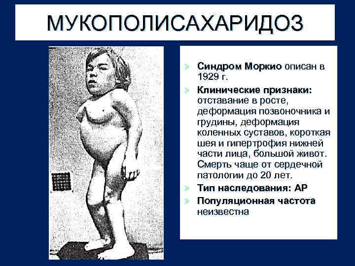 МУКОПОЛИСАХАРИДОЗ Синдром Моркио описан в 1929 г. Ø Клинические признаки: отставание в росте, деформация