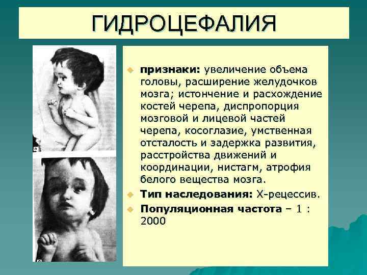 ГИДРОЦЕФАЛИЯ u u u признаки: увеличение объема головы, расширение желудочков мозга; истончение и расхождение