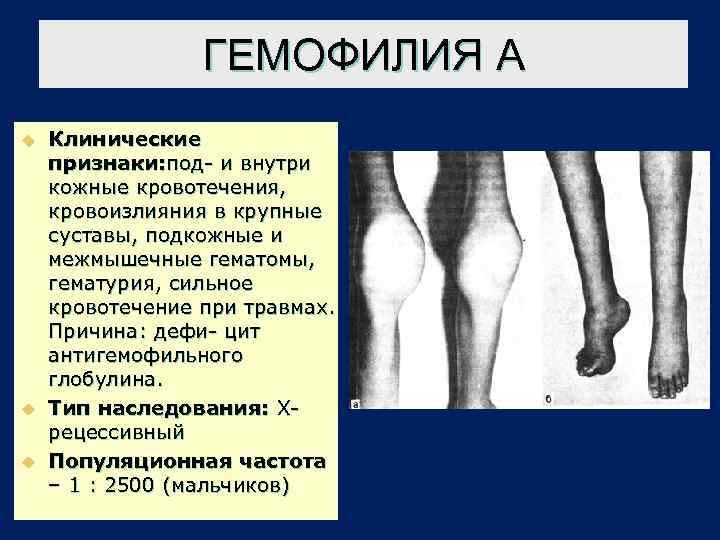 ГЕМОФИЛИЯ А u u u Клинические признаки: под- и внутри кожные кровотечения, кровоизлияния в