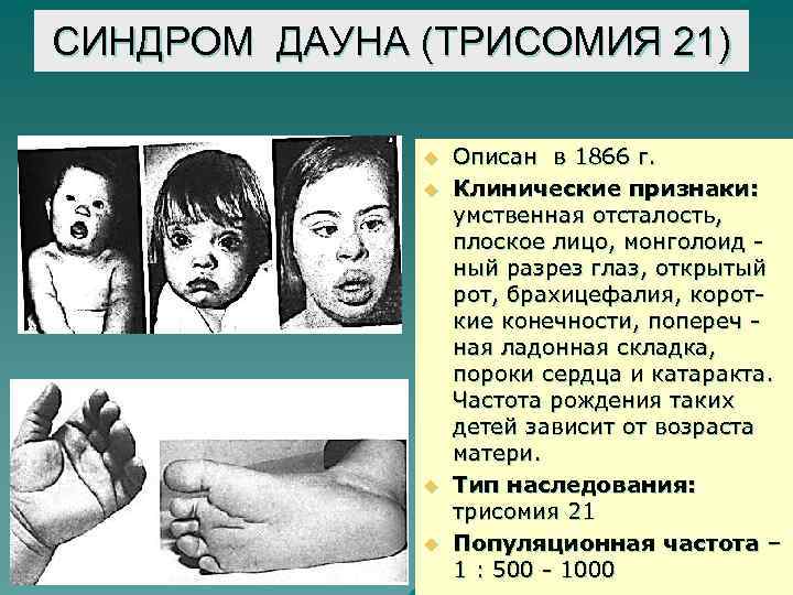 СИНДРОМ ДАУНА (ТРИСОМИЯ 21) u u Описан в 1866 г. Клинические признаки: умственная отсталость,