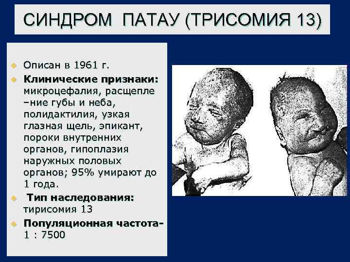 СИНДРОМ ПАТАУ (ТРИСОМИЯ 13) u u Описан в 1961 г. Клинические признаки: микроцефалия, расщепле