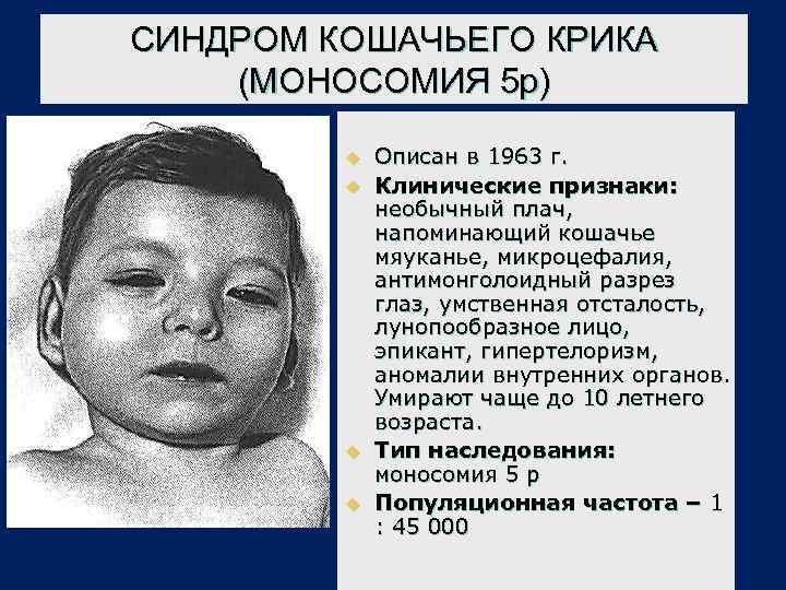 СИНДРОМ КОШАЧЬЕГО КРИКА (МОНОСОМИЯ 5 р) u u Описан в 1963 г. Клинические признаки:
